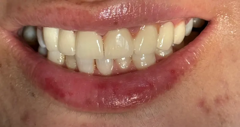 After: Front teeth, smiling, front view