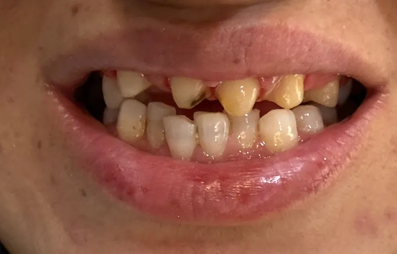 Before: Front teeth, smiling, front view