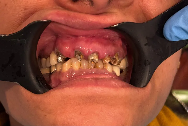 Before: Upper and lower front teeth, front view