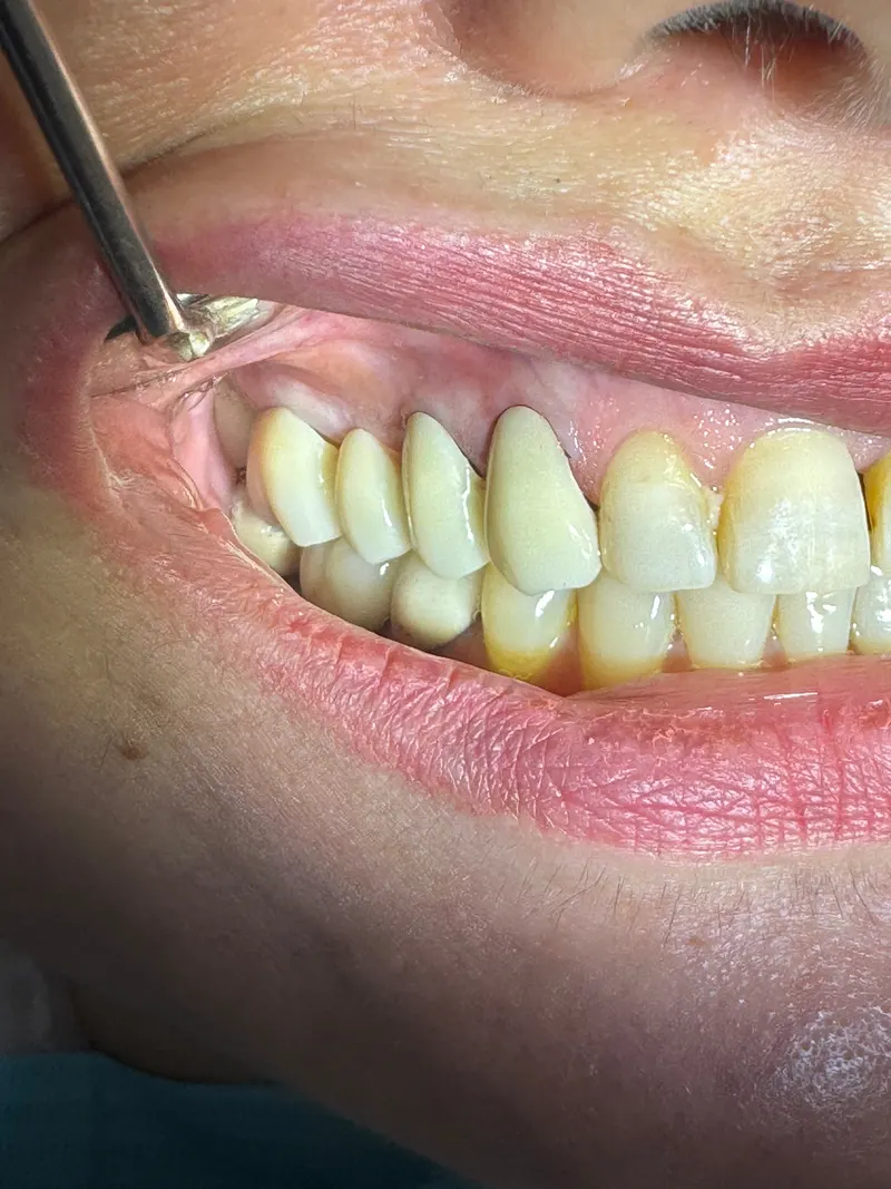 After: Upper teeth from the side, with a dental mirror