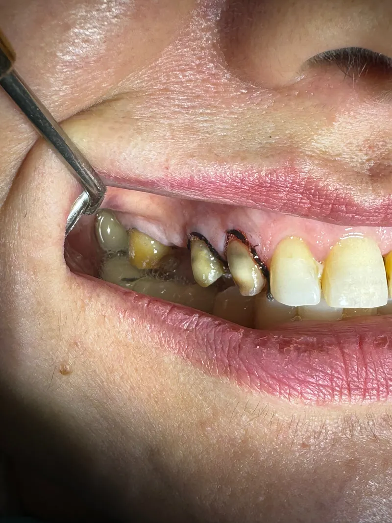 Before: Upper teeth from the side, with a dental mirror
