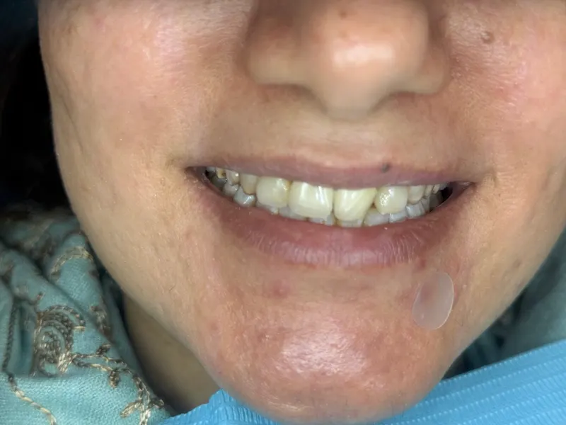 Before: Upper front teeth, smiling, front view