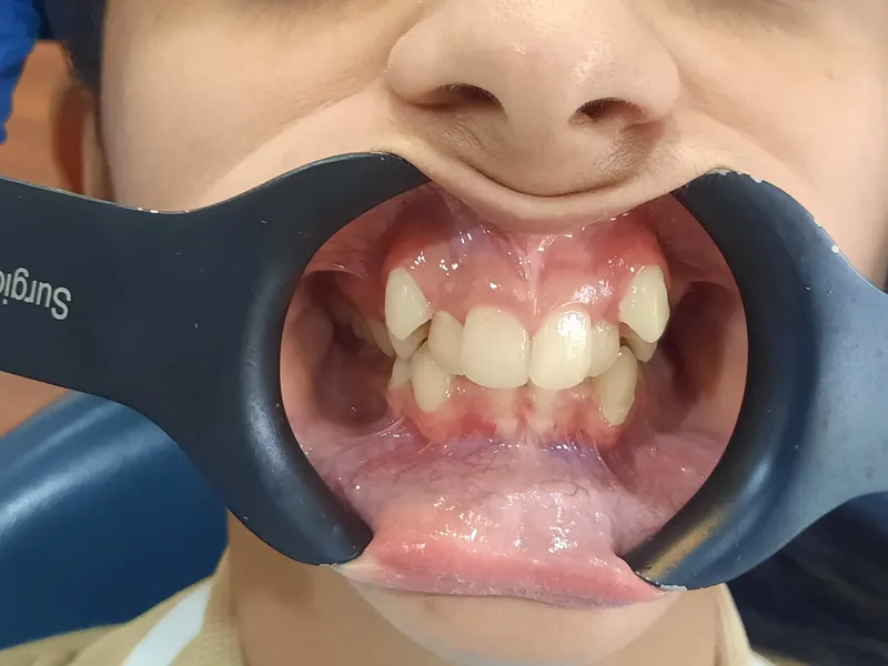 Before: Front teeth, front view