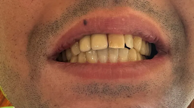 Before: Front teeth, smiling, front view