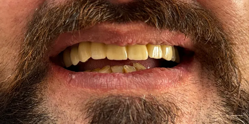 After: Upper front teeth, smiling, front view