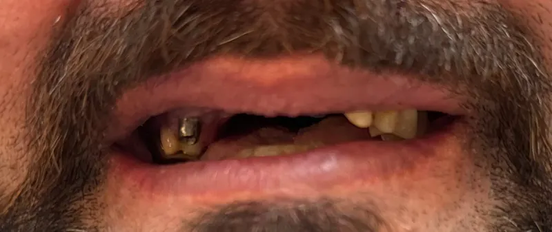 Before: Upper front teeth, smiling, front view