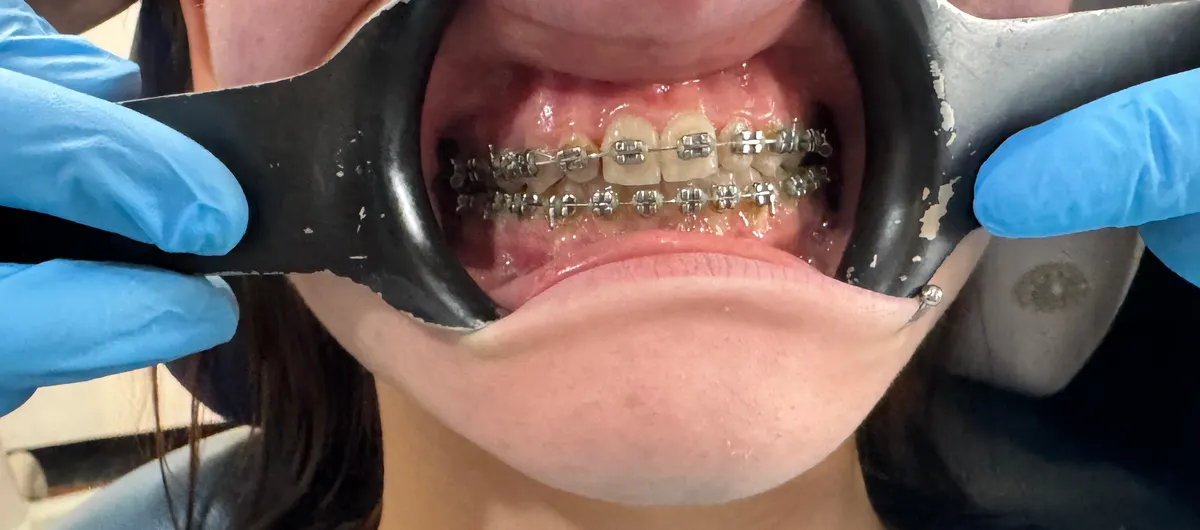 Close-up of teeth with fixed braces, held open with a cheek retractor.