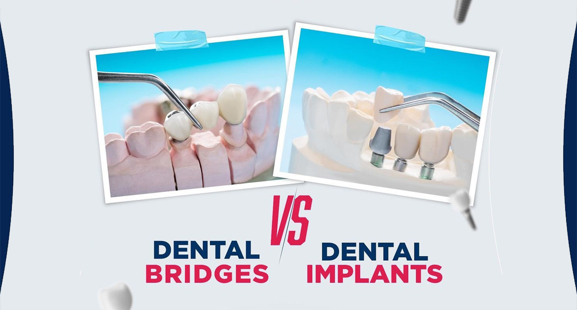 Dental Implant vs Dental Bridges